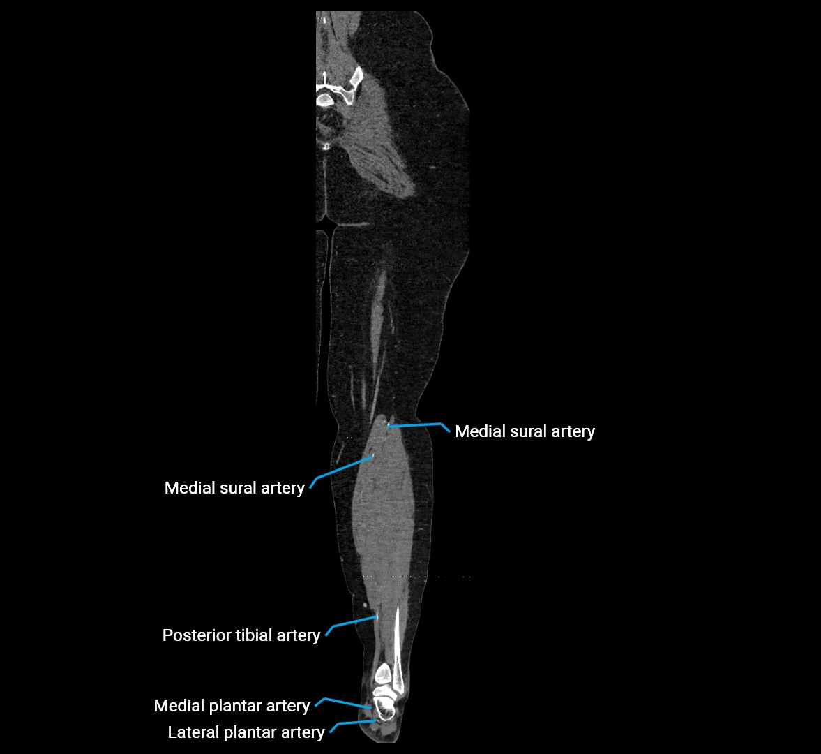 CTA lower limb coronal cross sectional anatomy labelled image _74 (2).webp